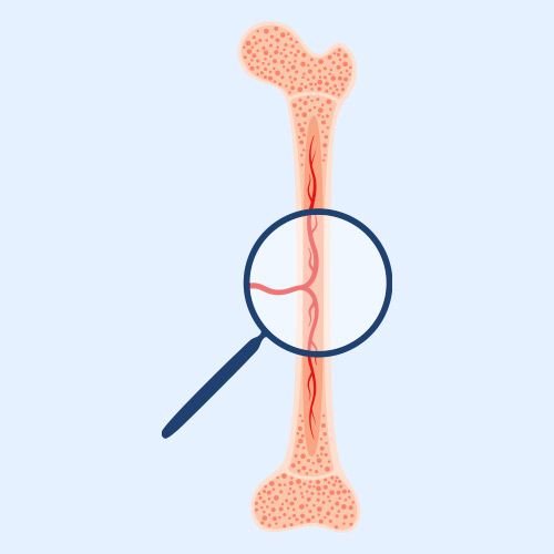 Bone Marrow Transplant