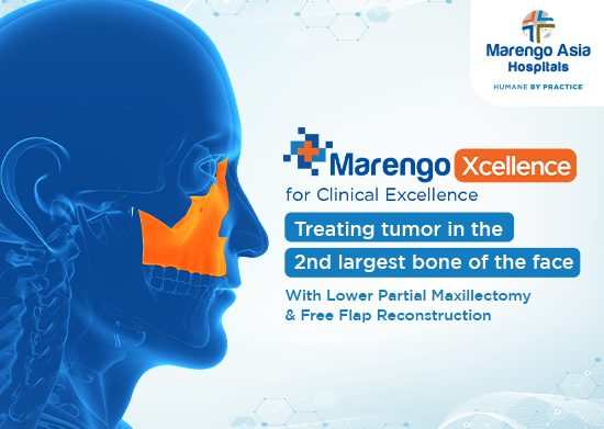 Successful Intraoral Lower Partial Maxillectomy with Free Flap Reconstruction for Giant Cell Tumor of the Maxilla