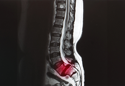 Spinal Stenosis: Symptoms Risk Factors and Treatment Strategies