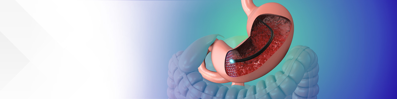 A Journey to Relief: Understanding POEM for Achalasia