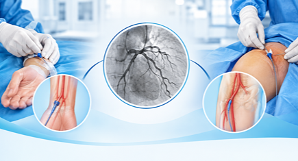Radial vs Femoral Angiography: Key Differences