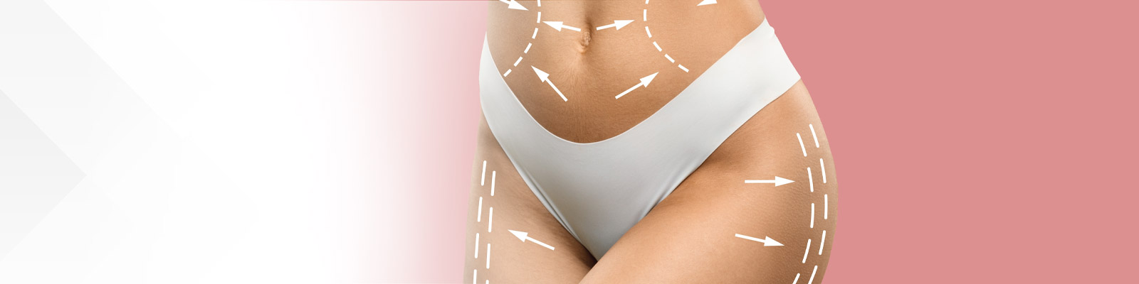 Common Misconceptions about Liposuction