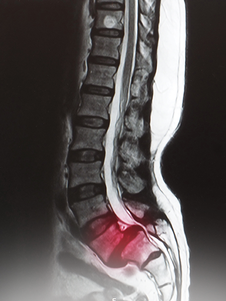 Spinal Stenosis: Symptoms Risk Factors and Treatment Strategies